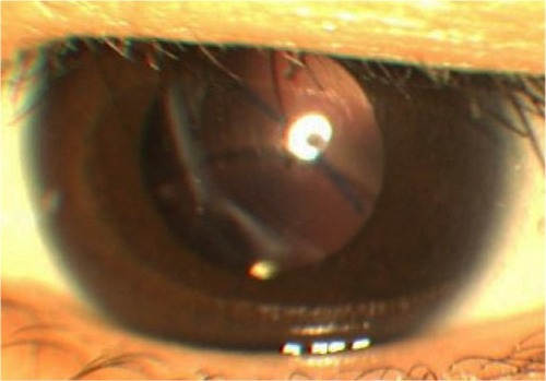 Figure 3 Slit lamp microscopy image of the patient’s left eye.