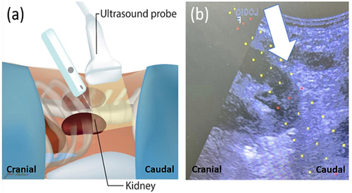 Figure 1 (a) Caudal direction of the needle with ultrasonogram probe, in which the tip of the needle angulated toward the legs. (b) Ultrasonogram imaging of caudal direction technique showing the needle trajectory line and target area of the biopsy. The white arrow indicates the direction of the biopsy needle.