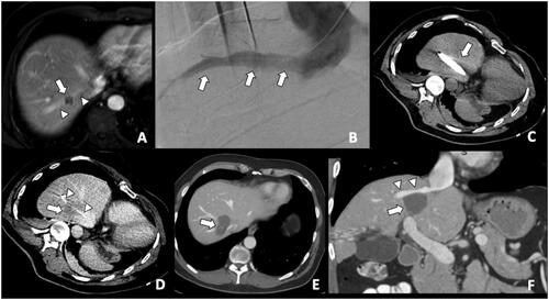 Figure 1. A colorectal liver metastasis abutting right hepatic vein treated by combination of percutaneous transhepatic venous temporary balloon occlusion of the right hepatic vein and microwave ablation to compensate the heat-sink phenomenon. (A) Magnetic resonance imaging demonstrating a tumor (arrow) abutting right hepatic vein (arrowheads); (B) Percutaneous transhepatic hepatic venography demonstrating the right hepatic vein (arrows); (C) Intra-procedural CT depicting inflated balloon catheter in the right hepatic vein during ablation; (D) A Clear ablation zone (arrow) covering the right hepatic vein, which is indicated by the catheter (arrowheads); (E) One month follow-up CT revealing satisfactory ablation zone (arrow) without residual tumor; (F) CT coronal multiplanar reconstruction demonstrating the ablation zone (arrow) and patent right hepatic vein (arrowheads).