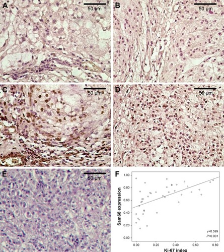 Figure 1 Representative expression of Sam68 and Ki-67 and their correlation in sacral chordomas.