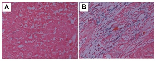 Figure 7 Prussian blue staining images of tumor tissues taken from mice at a time point 3 hours after injection of PEG-PCL-SPIONs (A) and Fa-PEG-PCL-SPIONs (B).Note: Blue stain density reflects the level of SPIO accumulation within tumor.Abbreviation: Fa-PEG-PCL-SPIONs, folate-attached poly(ethylene glycol)-poly(ɛ-caprolactone) superparamagnetic iron oxide nanoparticles.