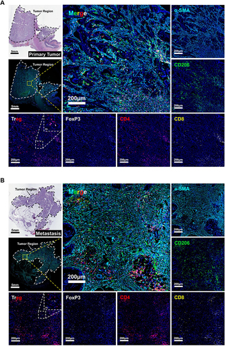 Figure 8 mIHC validation of cell infiltration in paired primary CRC and peritoneal metastases. (A-B) H&E staining images and mIHC multispectral fluorescence images of paired primary CRC and peritoneal metastases marked with the following six markers: α-SMA (sky blue), CD206 (green), CD8 (yellow), CD4 (red), FoxP3 (white), and DAPI (dark blue). The magnification of the tissue panorama is × 10, with a scale of 5 mm. The magnification of the enlarged local image is × 100, with a scale of 200 μm. The magnification scale of the enlarged image of Treg cells in the upper right corner is × 800, with a scale of 200 μm.