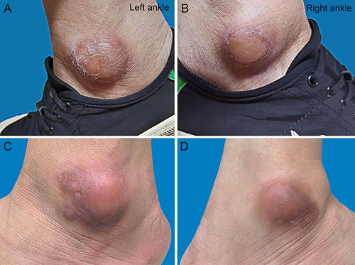 Figure 2 Plaques on both ankles before and after treatment. (A and B) Plaques on both ankles before treatment. (C and D) Two months after treatment.