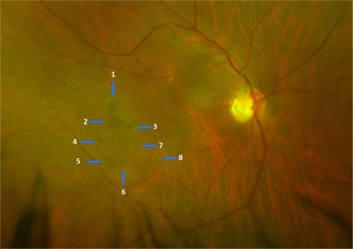 Figure 3 Color fundus image showing eight extrafoveal retinal holes (arrows/numbered).