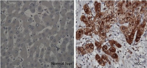 Figure 4 Immunohistochemical staining of hepatocytes in HCC and cirrhotic liver.