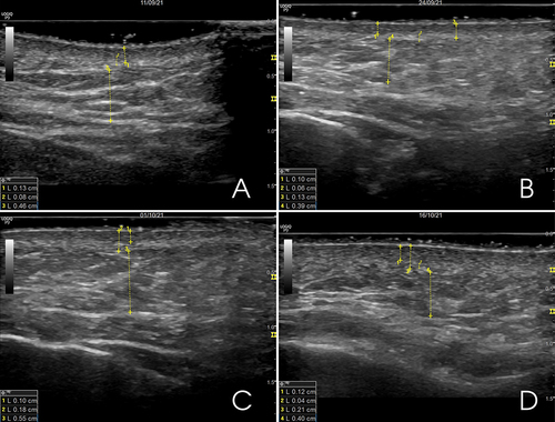 Figure 2 Ultrasound qualification of dermal changes of the left hemiface: (A) Before the injection procedure, (B) After 1 week, (C) After 2 weeks, (D) After 3 weeks.