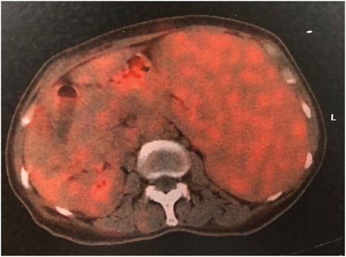 Figure 7. PET/CT showed an obvious splenomegaly was confirmed again and the SUV was about 2.3 with a Deauville Criteria 4 (the average SUV of the liver was 1.7)