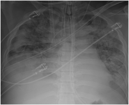 Figure 1. Chest x-ray on hospital day 7 demonstrating diffuse multifocal lung infiltrates