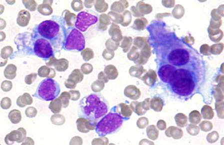 Figure 1. AML with t(3;3)(q21;q26.2). Presence of blasts and dysplastic megakaryocytes in aspirate smear (Wright, x400).