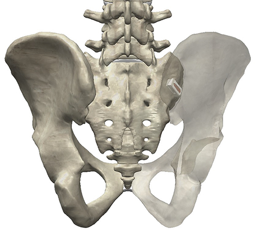 Figure 1 LinQ Allograft Implant is depicted within the right sacroiliac joint.