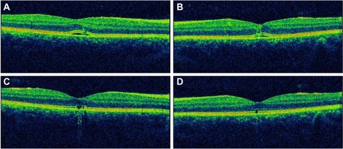 Figure 2 Optical coherence tomography. (A and B) Disruption of the outer retinal layers with nonspecific retinal thickening in both eyes at presentation. (C and D) Disruption of the inner segment/outer segment junction in both eyes, at 3 months after presentation.Note: A and C are right eye; B and D are left eye.