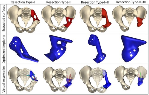 Figure 3. Topology-optimised prostheses for four resection types. Reproduced with permission from Ref. (Iqbal et al. Citation2019). Copyright 2019, Elsevier.