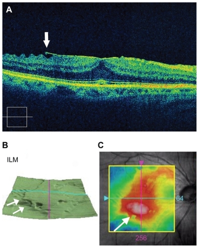 Figure 1 The right eye of a 71-year-old patient with idiopathic epiretinal membrane. All OCT images are obtained by spectral-domain OCT (Cirrus™ HD-OCT, Carl Zeiss Meditec, Jena, Germany). A) Horizontal image of optical coherence tomography (OCT) shows epiretinal membrane over the macula.. The arrow shows the identifiable edge of the membrane. B) Three dimensional retinal map images obtained by OCT. The arrows show the membrane that was elevated from the internal limiting membrane (ILM). C) Retinal map image obtained by OCT shows the range of epiretinal membrane. The arrow shows the thickest part of the membrane.