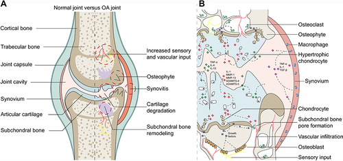 Figure 2 Macroscopic pathological changes and microscopic pathogenic relationships in OA joints. (A) Pathological changes in OA joints compared with normal joints. (B) Microscopic pathogenic interactions by cytokines in OA joints.