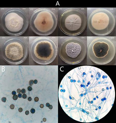 Figure 2 (A) The colonies on PDA and SDA after 7 days incubated at 25°C and 35°C; (B and C) Micromorphology examination showed hyphae hyaline and chlamydospores. Chlamydospores produced laterally or intercalary on hyphae, chlamydospores produced laterally or intercalary on hyphae, single-cell, thick-walled, brown, globose to subglobose.