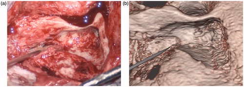 Figure 14. Snapshots comparing the actual (a) and virtual (b) procedures for a 63-year-old woman with a history of a left jugular foramen cholesteatoma who had underwent several procedures to remove the cholesteatoma. She subsequently underwent a left hypotympanic transjugular approach to the jugular foramen. The operative and simulation views show the approach used to access the jugular foramen and the pointer identifies the location of the cholesteatoma. This has not been segmented in the simulation view. Of note, no further drilling was required in this re-revision surgery and, as can be seen, the bony contours in the operative and simulation environments are similar.
