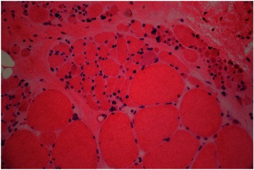 Figure 1 H&E stain revealed atrophic fibers of round or angular shapes that arranged in small and large groups with hypertrophied fibers. Fascicular atrophy was seen. Nuclear clumps were noted.