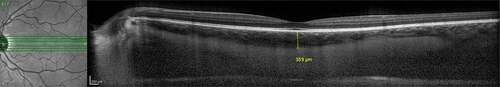 Figure 1. Representative measurement of SFCT with a built-in caliper, Heidelberg Spectralis