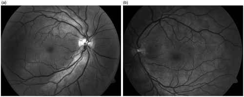 FIGURE 1. Red-free fundus photo shows clear delineation of multiple subretinal fluid pockets and retinal folds in the posterior pole in both eyes.
