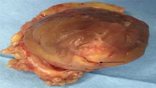 Figure 3 Accidental tumor incision during NSS.Abbreviation: NSS, nephron-sparing surgery.