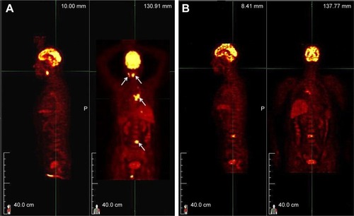 Figure 3 Positron emission tomography scans obtained before (A) and after (B) chemotherapy reveal decreases in hypermetabolism in the primary lesion and metastases (arrows).