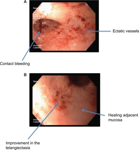 Figure 1 Chronic radiation proctitis (case 1) on endoscopy first look (A) and second look (B).