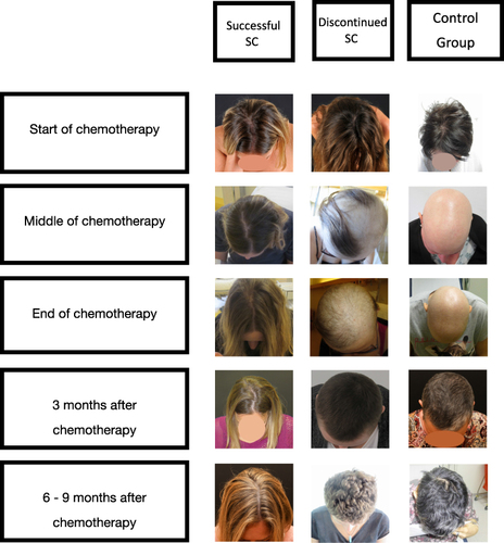 Figure 2 Patient examples of scalp cooling results over the course of CT treatment.