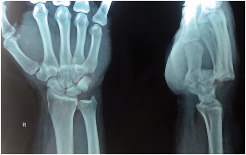 Figure 1. PA and lateral views of wrist.