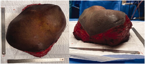 Figure 3. Tumor after resection. Notice the base of the tumor to be slightly smaller than the superficial component.