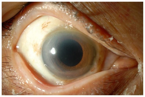 Figure 1 Preoperative anterior segment of the right eye. No lens is present.