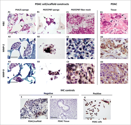 Figure 5. Light micrographs of histologic sections of PDAC cell/scaffold constructs (A–C) and tumor tissue (D): (A) PVA/G sponge, (B) PEOT/PBT sponge, and (C) PEOT/PBT fiber mesh. (A1–D1) Hematoxylin and eosin (H&E) staining, showing cell morphology (original magnification 20×), IHC of (A2-D2) MMP-2 and (A3–D3) MMP-9 (original magnifications 40×). Arrows indicate organized clusters of cell with duct formation; “sc” indicates the scaffold material. (E–G) Some controls of IHC reactions: (E and F) negative controls, i.e., omitting the primary antibody MMP-2, (G) positive control of MMP-2 performed on a PDAC cell line. Scale bar = 50 μm.