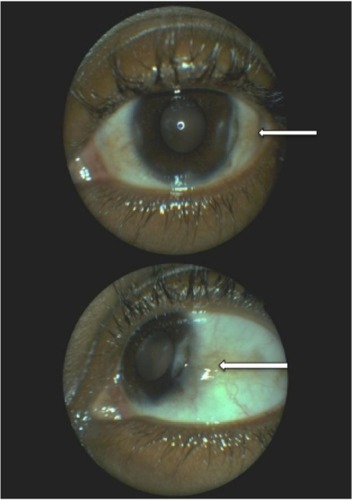 Figure 3 Left eye lesion 1 month after initiating the treatment with sulfasalazine.