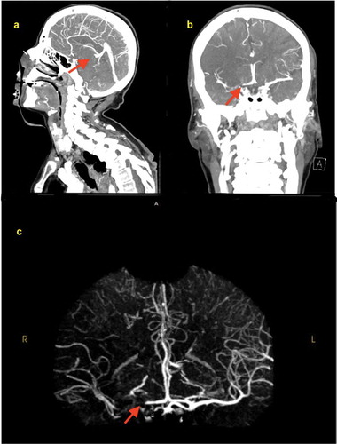 Figure 3. CT angiography of the head and neck with IV contrast