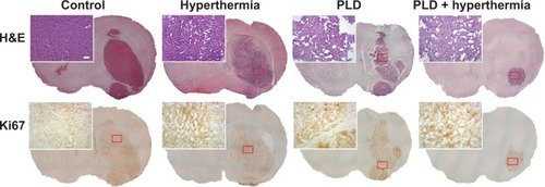 Figure 5 Histological (H&E) and immunohistochemical (Ki67) staining performed in tumor regions following the different treatments.Notes: Mice were implanted with 4T1-luc2 tumor cells with treatment performed on day 6. The mice were sacrificed on day 11. Tumor slices were then obtained for staining. Tumors treated with PLD + hyperthermia had smaller tumors than the control group based on H&E staining (upper panels). Ki67 expression was associated with cell proliferation. Mild Ki67 expression was found in the tumor area of the PLD + hyperthermia-treated group. Scale bars =100 μm and 1 mm, respectively.Abbreviations: PLD, pegylated liposomal doxorubicin; H&E, hematoxylin and eosin.