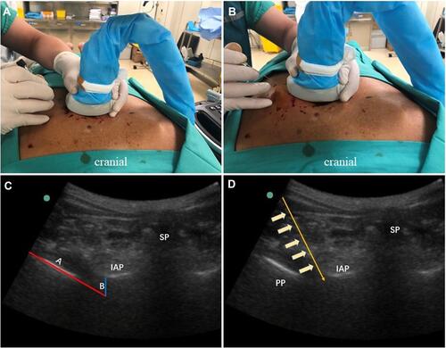 Figure 2 In-plane puncture was performed laterally to medially. (A) Ultrasonic probe and thoracic vertebra are in transverse position. (B) The probe could be rotated 5–15 degrees toward the caudal end to avoid the rib or scapula. (C) Oblique line A (red) and vertical line B (blue) were marked along the edges of the PP and IAP on ultrasonography, respectively. The starting point of line B was the IAP, and the end point was the intersection with line A. The midpoint of line B was the puncture end-point. (D) Puncture with a 22-gauge Tuohy needle using the in-plane technique.