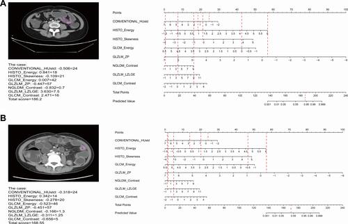 Figure 5 (A) Example of adopting nomogram in the patient who was LOR to IFX therapy in CD. (B) Example of adopting nomogram in the patient who was response to IFX therapy in CD.