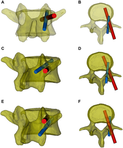 Figure 6 The trajectory relationship between the pedicle screw and CBT screw. The red cylinder represents the pedicle screw, and the blue cylinder represents the CBT screw. (A and B) Using the standard screw placement technique, the trajectories of the pedicle screws and CBT screws partially overlap in the pedicle. (C and D) The original pedicle is close to the inferior wall of the pedicle, and the new CBT screw will course along the superior aspect of the original pedicle screw. (E and F) The original pedicle is close to the superior wall of the pedicle, and the new CBT screw will course under the original pedicle screw.