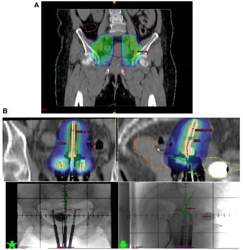 Figure 2 (A) Parametrial boost (planning target volume [PTV]-2) of 5.4–9 Gy with midline shielding, followed by (B) high-dose rate brachytherapy of 21 Gy in three sessions, in the two treatment groups (rectum on the left and bladder on the right).