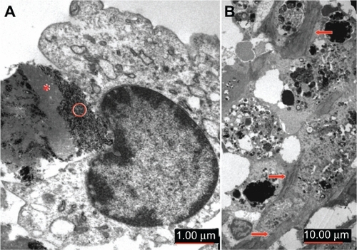 Figure 6 Ultrastructural aspect of implant/tissue interaction as seen on transmission electron microscopy. (A) Detailed view of early phase of implant degradation showing ongoing engulfment of the superparamagnetic iron oxide nanoparticles-albumin complex by activated monocytes. Heterogeneous electron density of implant material is seen, with electron-lucent zones corresponding to coagulated albumin (*) whereas dense granules represent iron nanoparticles (○). (B) Organizing phase of implant scavenging is characterized by phagocytic cells replete with electron-dense iron particles. Note intercellular deposition of connective tissue fibers (arrows). Original magnification is indicated by scale bars.