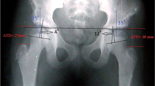 Figure 2. Preoperative epiphyseal and acetabular coverage angles in a bilateral type-II AVN patient.
