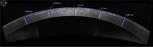 Figure 2 High-definition optical coherence tomography measurements.