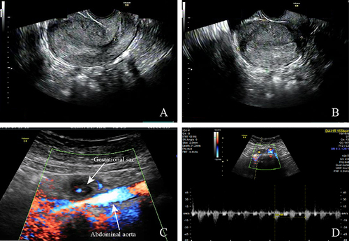 Figure 1 The ultrasound examination before the laparoscopy.