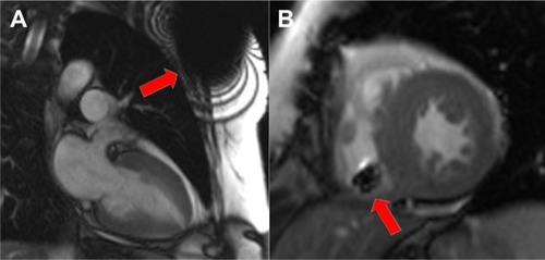 Figure 1 Balanced steady-state free precession (b-SSFP) cine images of the heart in a patient with an implanted magnetic resonance imaging-conditional pacemaker.