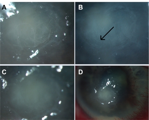 Figure 2 (A) Magnified view of fibrils at the ulcer base at four months. (B) which were absent after immediate removal. (C) shows presence of fibrils (indicated by arrow head) the following week. (D) shows resolution of hyopyon with infiltration and injection of the globe in absence of fibrils.
