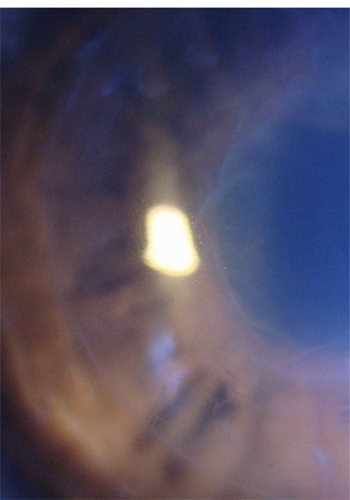 Figure 6 Postoperative Descemet’s membrane wrinkles.