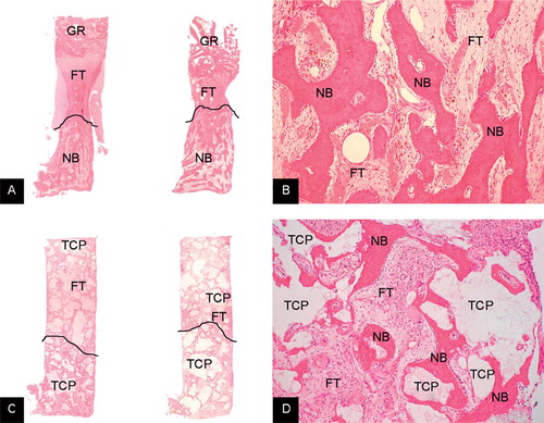 Figure 2. A. Typical examples of the bone chamber content of allograft control (left) and allograft with high-dose OP-1 (right). Graft remnants (GR) are still present in the top of the specimen. New bone (NB) formation takes place from the ingrowth openings upward to the top of the chamber. Ffibrous tissue (FT) precedes the front of bone ingrowth. The line demarcates this front. Hematoxylin-eosin stained section. Magnification: 12.5×. B. Detail of allograft with high-dose OP-1 specimen showing newly formed bone at the bottom of the chamber. There were no differences in appearance of newly formed bone between the controls and either low-dose or high-dose OP-1 specimens. Hematoxylin-eosin stained section. Magnification: ×100. C. Typical examples of the bone chamber content of TCP/HA control (left) and TCP/HA (TCP) with high-dose OP-1 (right). There are TCP/HA granules throughout the entire specimen. New bone (NB) formation takes place from the ingrowth openings upward to the top of the chamber. Ffibrous tissue precedes the front of bone ingrowth. New bone is apposited on the TCP/HA granules at the bottom of the chamber. The front is again indicated by a line. Hematoxylin-eosin stained section. Magnification: ×12.5. D. Detail of TCP/HA specimen with high-dose OP-1 showing new bone (NB) apposited on the TCP/HA granules (at the bottom of the chamber). There were no differences in appearance of newly formed bone between the controls and either low-dose or high-dose OP-1 specimens. Hematoxylin-eosin stained section. Magnification: ×100.