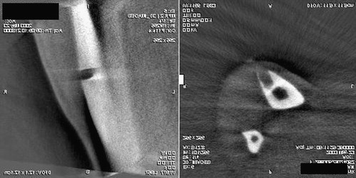 Figure 9. Intraoperative Iso-C3D® control scan after navigated resection of the lesion at the distal tibia.