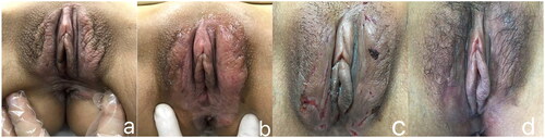 Figure 2. Side effects after FU treatment at 2.5 mm focal depth and the recovery of symptomatic treatment. (a) one patient’s vulvar lesion before FU treatment, (b) the same patient’s vulvar condition immediately after FU treatment, (c) the same patient’s ulcer 10 days after operation and (d) the same patient’s recovery after symptomatic treatment for 2 months after FU therapy.