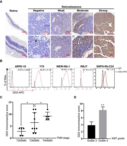 Figure 1 GD2 is highly expressed in retinoblastoma and is related to an advanced stage and fast proliferation. (A) Representative images of heterogeneous GD2 staining in retinoblastoma tissues (n=54). The staining intensity was classified as negative, weak, moderate or strong by two experienced pathologists. Normal retina tissues (n=13) were stained as a negative control. (B) The percentage of GD2-positive cells was estimated by FC in the normal control cell line ARPE-19, two retinoblastoma cell lines Y79 and WERI-Rb-1, and two primary retinoblastoma cultures RBJY and SNPH-Rb-C24. Numerical values denote the mean ± SD. (C) The correlation of the GD2 IRS with TNM stage in GD2-positive retinoblastoma species. The sample from TxN1M0/TxN0M1 was excluded due to the small population (n=1). Numerical values denote the mean ± SD. *p < 0.05 by one-way ANOVA. (D) The average GD2 IRS between the grade 3 and grade 4 Ki67 groups. Numerical values denote the mean ± SD. **p < 0.01 by Student’s t-test.