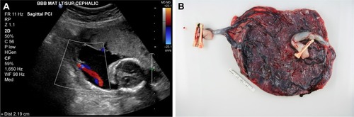 Figure 1 (A) Color flow Doppler ultrasound showing velamentous umbilical cord inserting into fetal membranes, 2.19 cm off of placental disk for twin B in a monochorionic, diamniotic twin pregnancy identified at 20-week gestation. (B) Delivered monochorionic, diamniotic twin placenta at 30 weeks from same pregnancy as (A). There is a velamentous insertion of the umbilical cord for twin B (two clamps). Note the division of cord vessels within the fetal membranes and before they join the placental disk at multiple sites along the margin; insufficient imaging can confuse these vessels with a marginal cord insertion. The umbilical cord insertion site of twin A (one clamp) is inserted at the margin of the disk. This pregnancy was complicated by late-onset twin-to-twin transfusion syndrome with twin B, the donor, and twin A, the recipient.